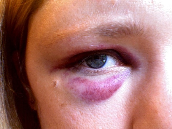 black eye sugarsnaptastic